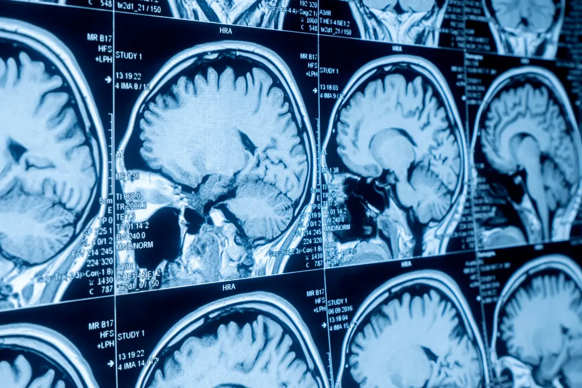 Determining the Long-term Costs of a Brain Injury