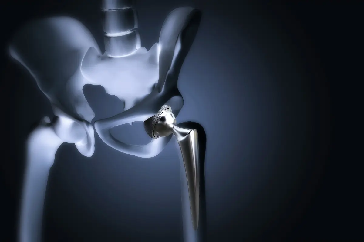 DePuy All-Metal Hip Implants: Like Metal Grinding On Metal
